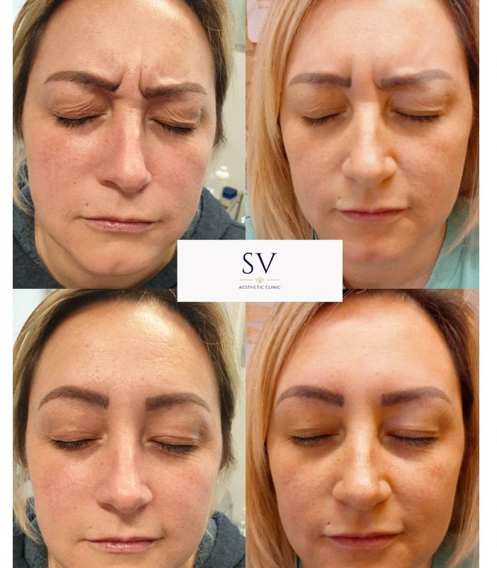 anti wrinkle manchester