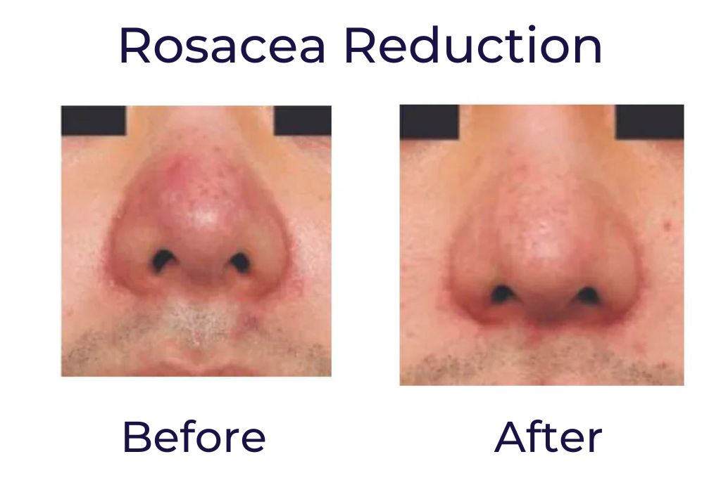 Rosacea Reduction