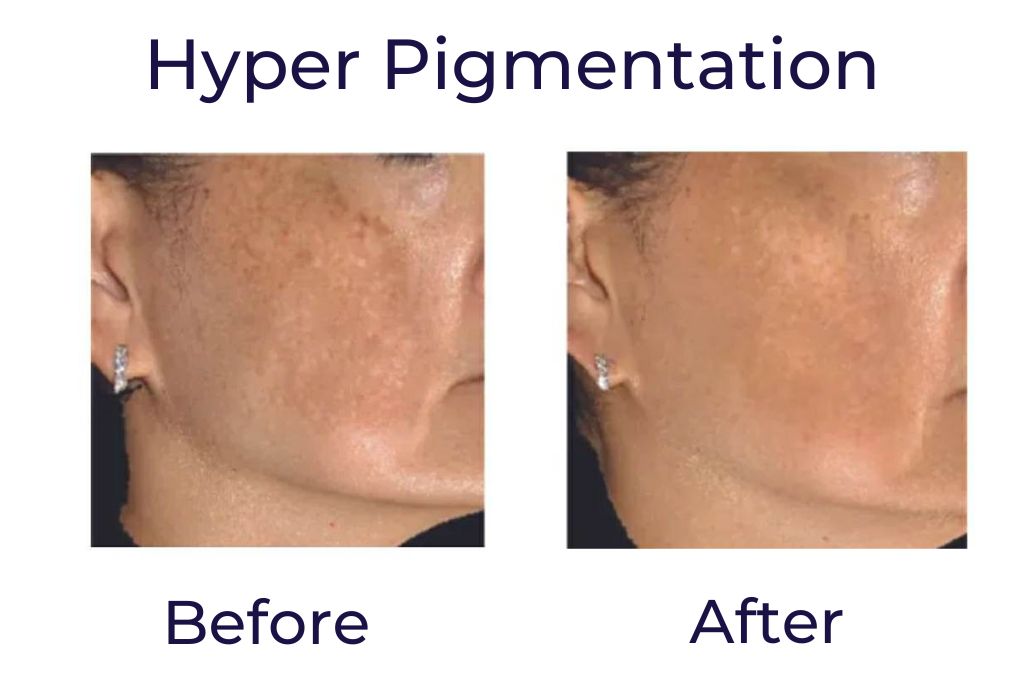 hyper pigmentation