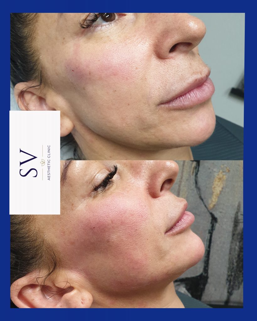 Chin enhancement manchester