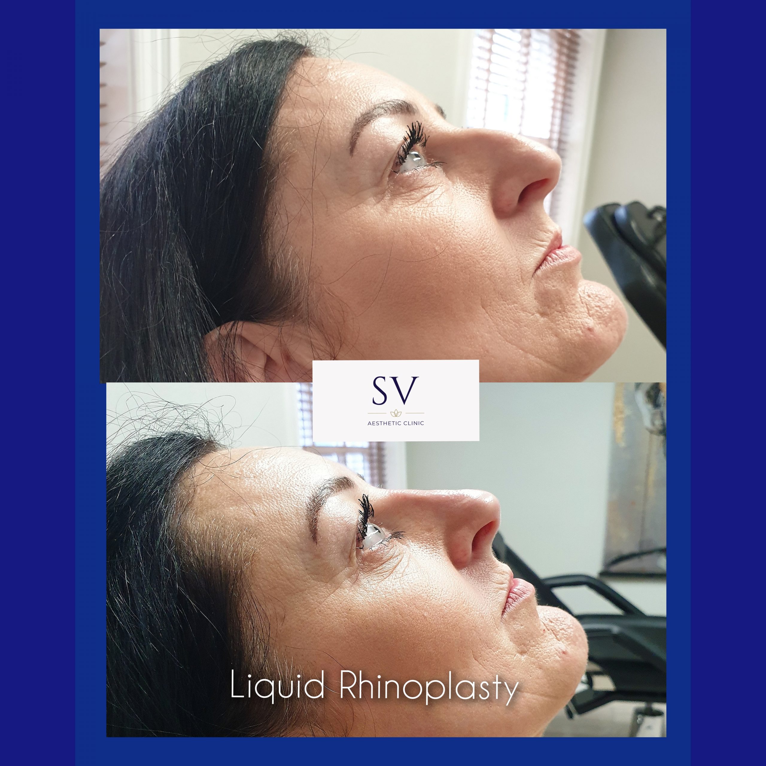 Non - surgical Rhinoplasty manchester
