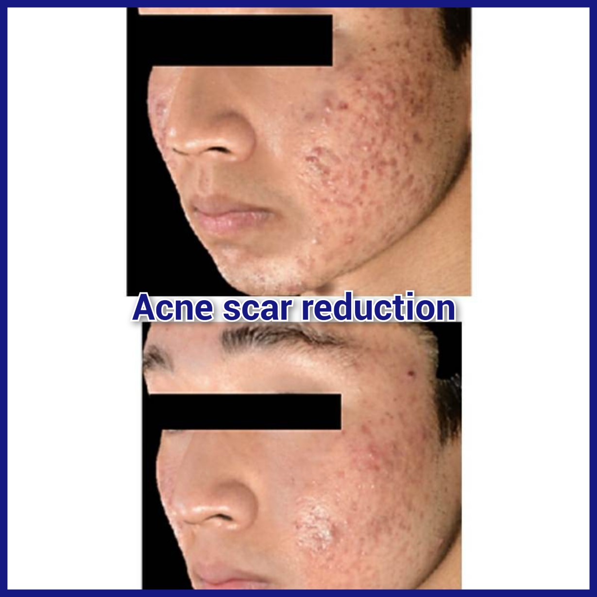 Thumbnail for Acne Scarring And Acne Laser Treatment In Hale And Altrincham